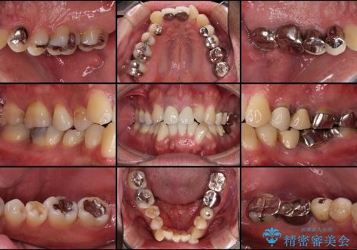奥歯の目立つ銀歯を白くしたいの症例 治療前
