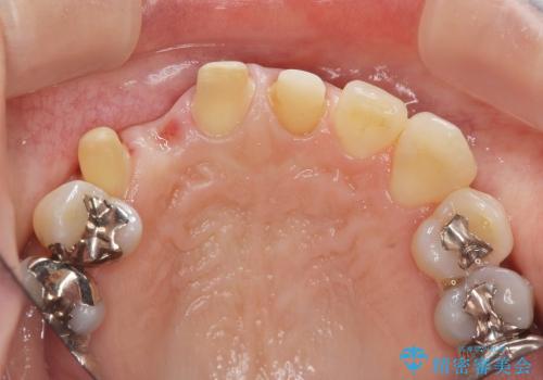 [セラミックを用いた前歯の歯並び治療 ②]  歯ぐきの成熟 ー 最終支台形成 ー セラミッククラウン・ブリッジの作製の治療中