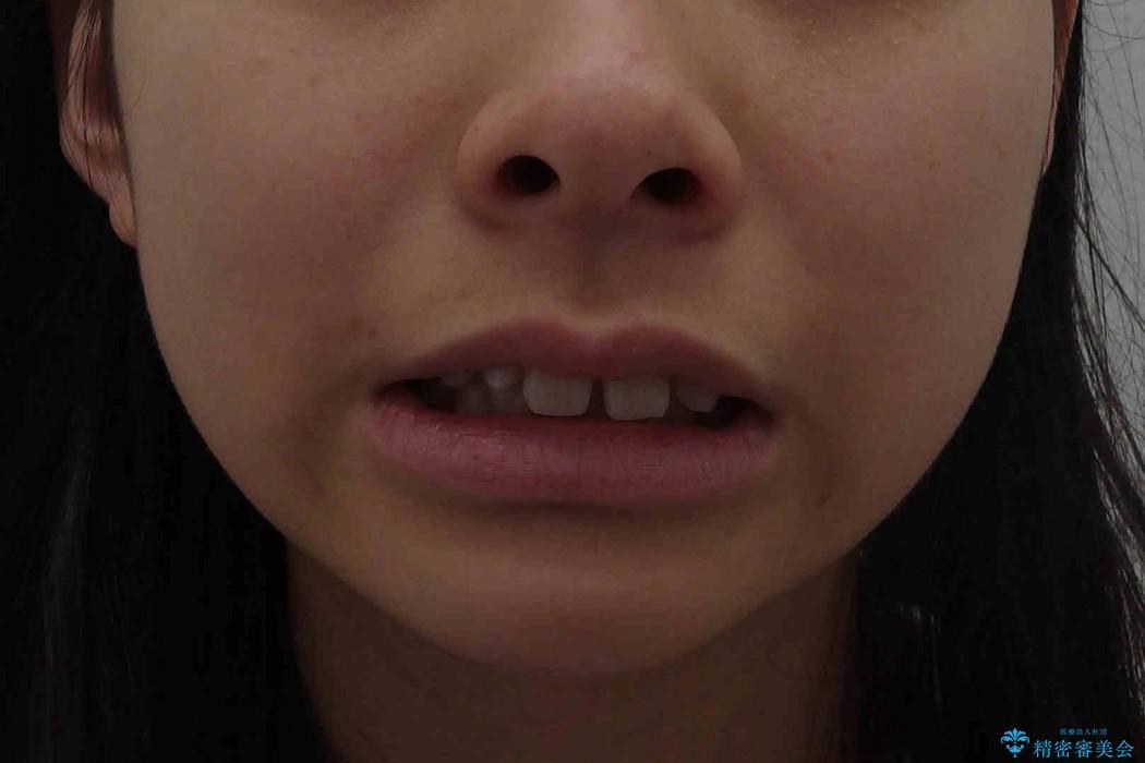 [10代女子]　すきっ歯　上の矮小歯・先天欠如　天然歯で隙間をつめる治療の治療前（顔貌）