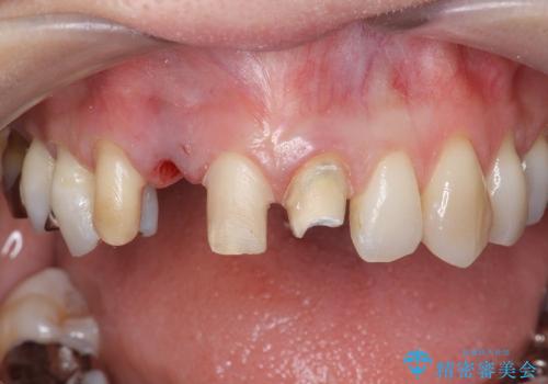 [セラミックを用いた前歯の歯並び治療 ①] 術前診断 ー 抜歯・仮歯の作製の治療中