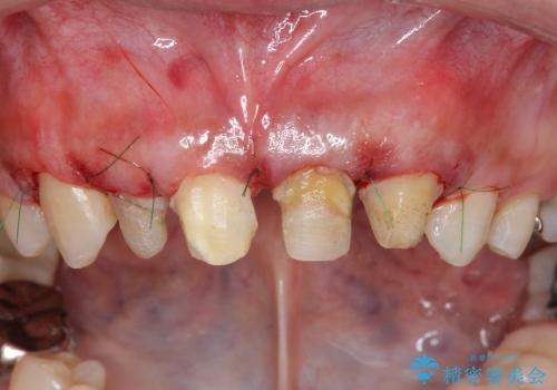 [歯ぐきの環境を整えてからの前歯の審美治療 ②]  歯周外科手術治癒後のセラミッククラウン作製の治療前