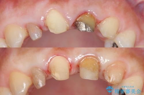 [歯ぐきの環境を整えてからの前歯の審美治療 ②]  歯周外科手術治癒後のセラミッククラウン作製