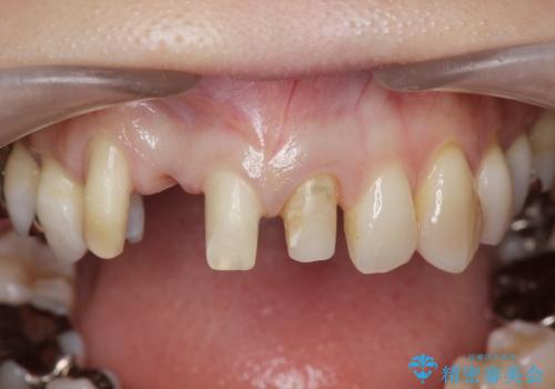 [セラミックを用いた前歯の歯並び治療 ②]  歯ぐきの成熟 ー 最終支台形成 ー セラミッククラウン・ブリッジの作製の治療中