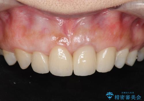 [歯ぐきの環境を整えてからの前歯の審美治療 ②]  歯周外科手術治癒後のセラミッククラウン作製の症例 治療後