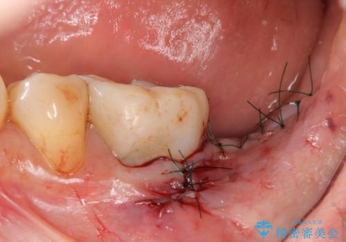 [ 大臼歯部骨造成・インプラント治療① ] 骨造成 ー インプラント埋入の治療後