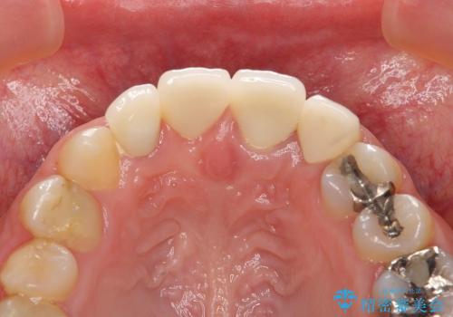 [歯ぐきの環境を整えてからの前歯の審美治療 ①] クラウンの除去 - 仮歯の作製 - 歯周外科手術の治療前