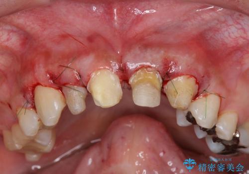 [歯ぐきの環境を整えてからの前歯の審美治療 ①] クラウンの除去 - 仮歯の作製 - 歯周外科手術