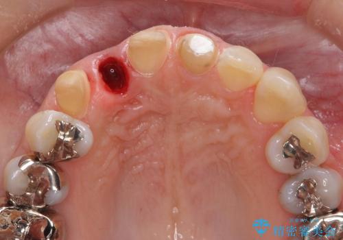 [セラミックを用いた前歯の歯並び治療 ①] 術前診断 ー 抜歯・仮歯の作製の治療中