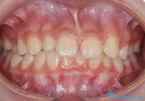 [10代女子]　すきっ歯　上の矮小歯・先天欠如　天然歯で隙間をつめる治療の症例 治療前
