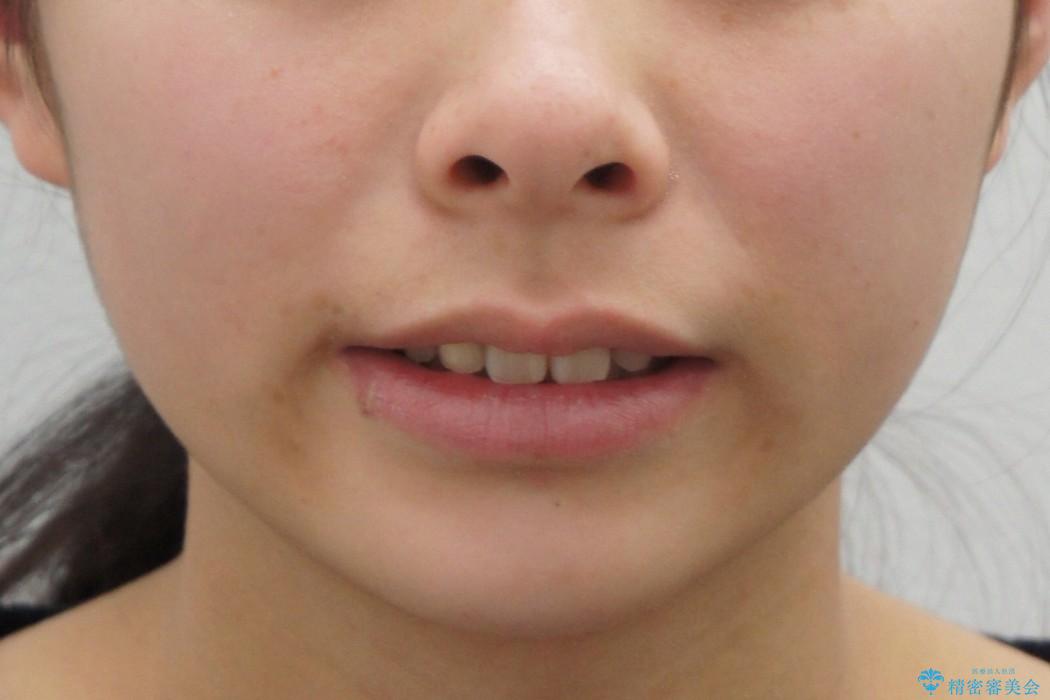 [10代女子]　すきっ歯　上の矮小歯・先天欠如　天然歯で隙間をつめる治療の治療後（顔貌）