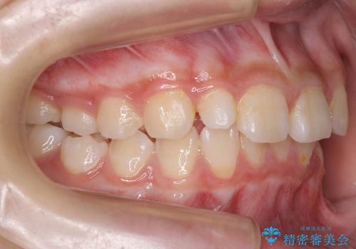 [10代女子]　すきっ歯　上の矮小歯・先天欠如　天然歯で隙間をつめる治療の治療前