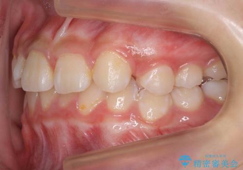 [10代女子]　すきっ歯　上の矮小歯・先天欠如　天然歯で隙間をつめる治療の治療前