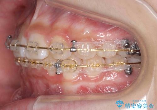 [10代女子]　すきっ歯　上の矮小歯・先天欠如　天然歯で隙間をつめる治療の治療中