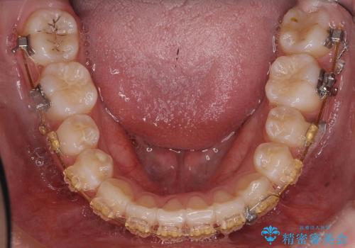 [10代女子]　すきっ歯　上の矮小歯・先天欠如　天然歯で隙間をつめる治療の治療中