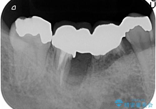 [乳歯の晩期残存]  残せない乳歯のインプラントによる咬合回復の治療前