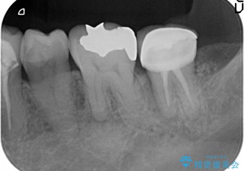 [ 大臼歯部骨造成・インプラント治療① ] 骨造成 ー インプラント埋入の治療前