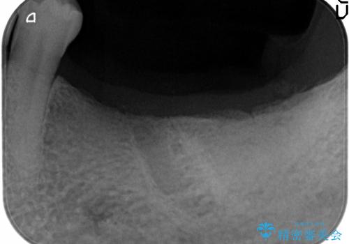 奥歯の喪失　インプラントによる咬合回復の治療前