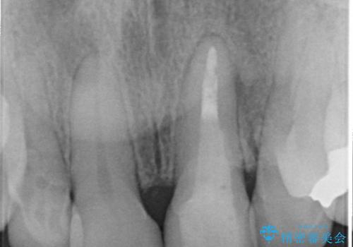 [歯ぐきの環境を整えてからの前歯の審美治療 ②]  歯周外科手術治癒後のセラミッククラウン作製の治療後