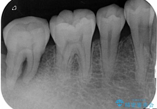 保存不可能な歯の抜歯後のインプラント治療