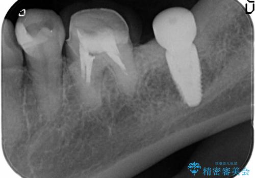 [ 大臼歯部骨造成・インプラント治療② ]  インプラント2次手術 ー ジルコニアカスタムアバットメント・クラウンの作製の治療前