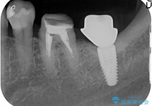 [ 大臼歯部骨造成・インプラント治療② ]  インプラント2次手術 ー ジルコニアカスタムアバットメント・クラウンの作製の治療中