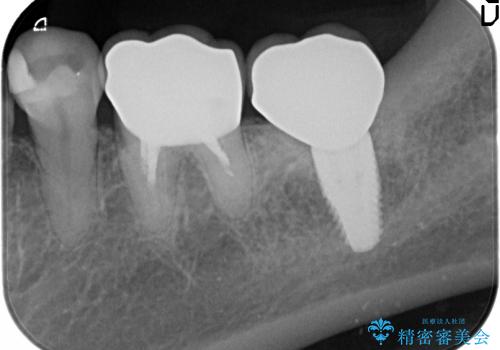 [ 大臼歯部骨造成・インプラント治療② ]  インプラント2次手術 ー ジルコニアカスタムアバットメント・クラウンの作製の治療後