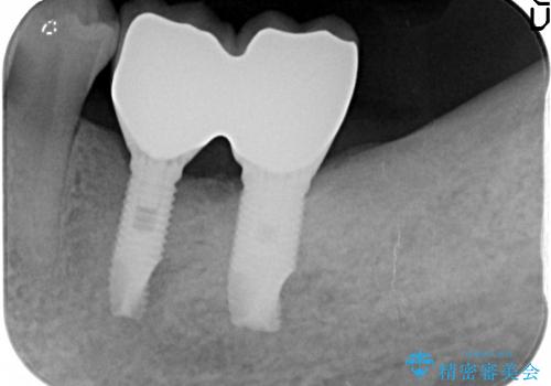 奥歯の喪失　インプラントによる咬合回復の治療後