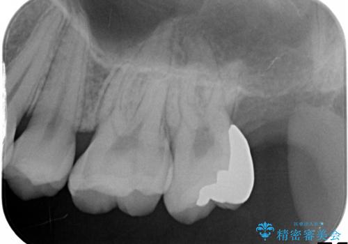 20代女性　奥歯の更に奥、処置困難な虫歯の治療後