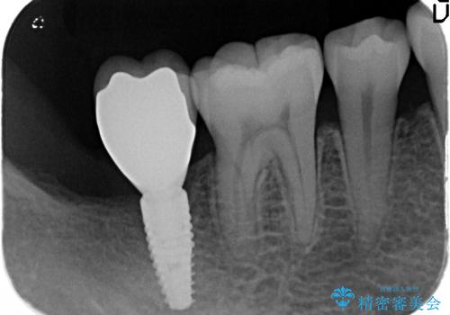 保存不可能な歯の抜歯後のインプラント治療の治療後