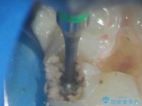 [セラミックインレー]  顕微鏡を用いた精密虫歯治療の治療中