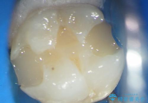 [セラミックインレー]  顕微鏡を用いた精密虫歯治療の治療中