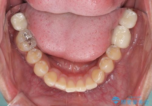 奥歯が虫歯だらけ　セラミックやインプラントによる虫歯治療の治療後