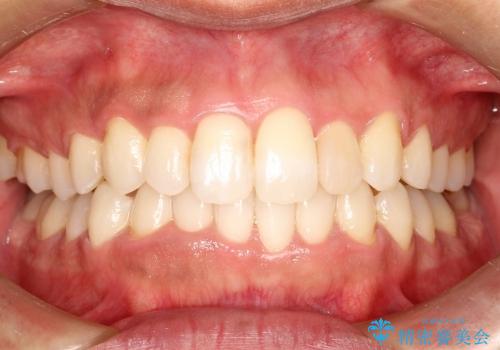 30代男性 フルリンガルによるガタつき八重歯の改善の症例 治療後