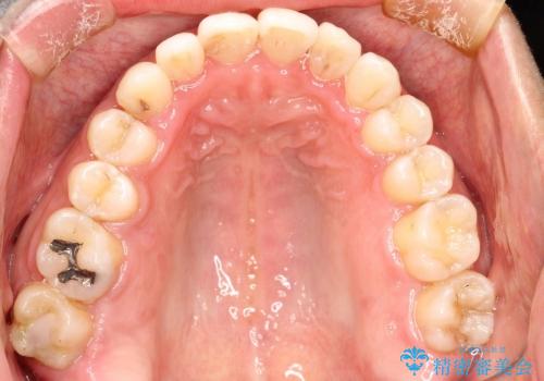 30代男性 フルリンガルによるガタつき八重歯の改善の治療後