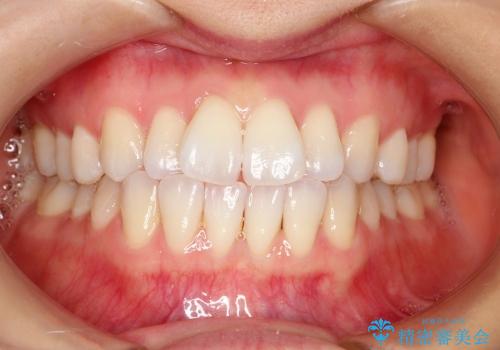 出っ歯、歯のねじれをインビザラインにて治療の症例 治療前