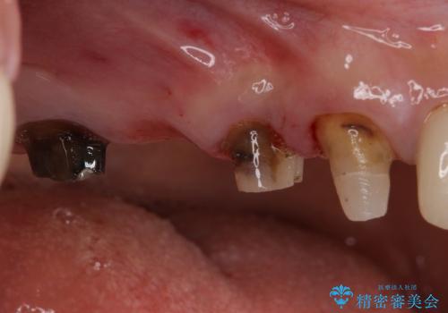 深い歯周ポケットを除去する歯周外科処置の治療中