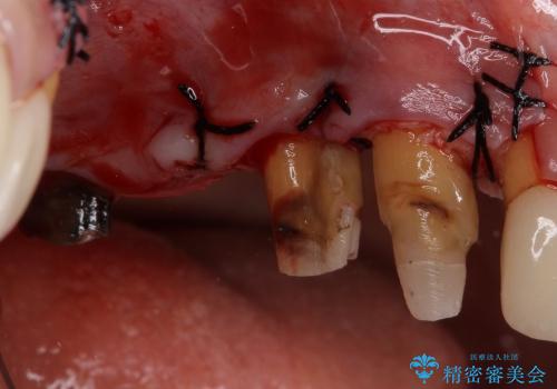 深い歯周ポケットを除去する歯周外科処置の治療中