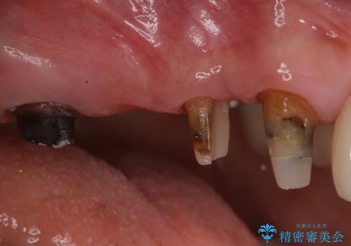 深い歯周ポケットを除去する歯周外科処置の治療後