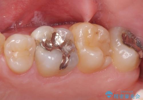 前歯のセラミック　放置した虫歯の全体的な治療の治療前