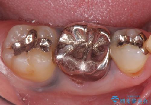 前歯のセラミック　放置した虫歯の全体的な治療の治療前