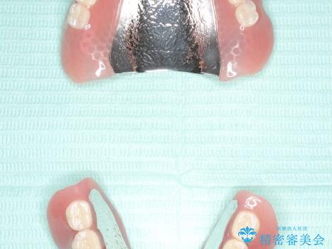 入れ歯が全く合わない　金属床を用いた総義歯の治療後