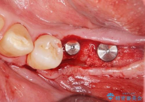 奥歯の喪失　インプラントによる咬合回復の治療中