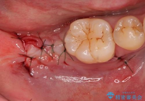 保存不可能な歯の抜歯後のインプラント治療の治療中