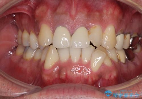 奥歯の目立つ銀歯を白くしたいの治療前