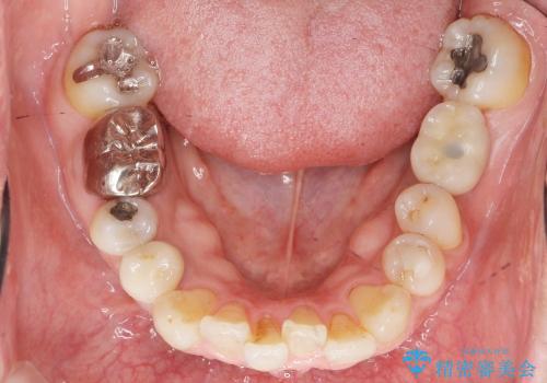 奥歯のインプラント　50代男性の治療後