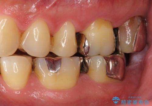 奥歯の銀のつめものを白く　セラミックインレーの治療前