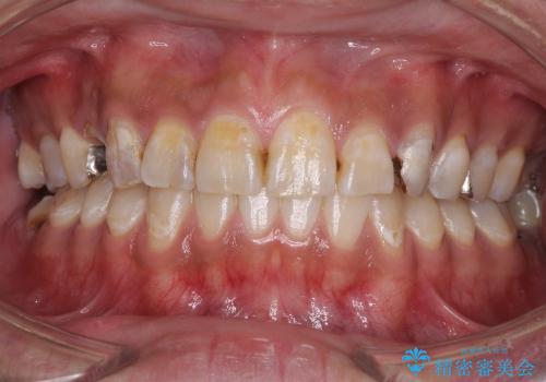 奥歯が虫歯だらけ　セラミックやインプラントによる虫歯治療の治療前