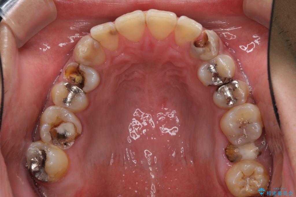 歯医者 虫歯 だらけ の 患者