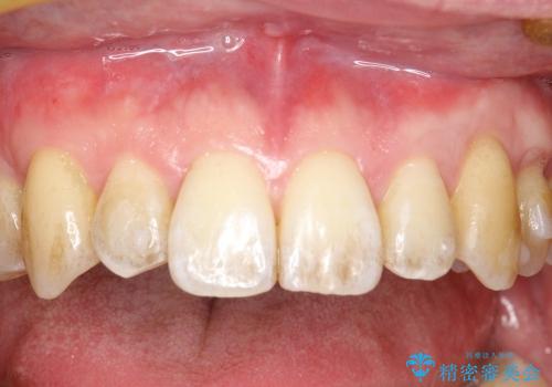 犬歯　歯ぐきの移植　三年経過症例の治療後