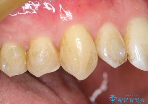 犬歯　歯ぐきの移植　三年経過症例の治療後